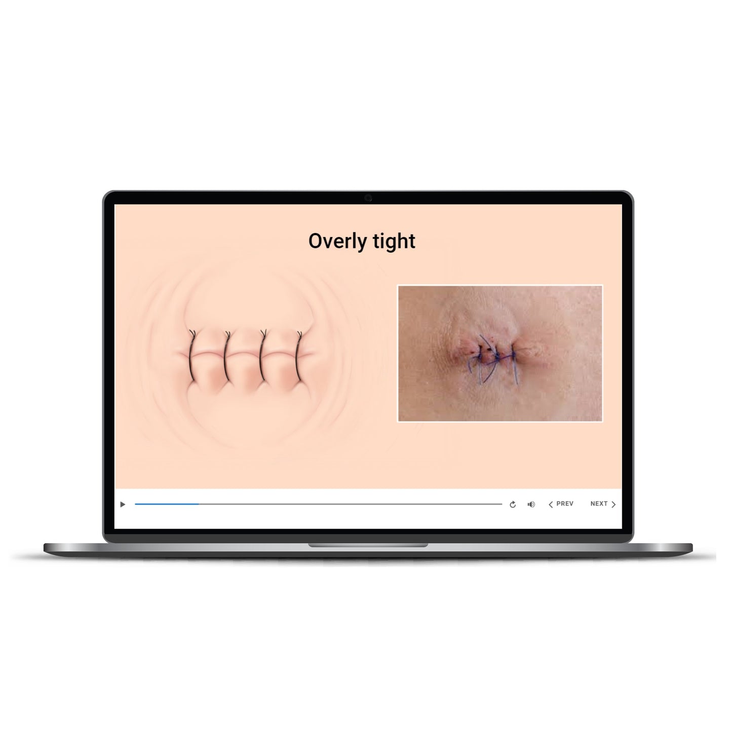 AAD Hands-on at Home Dermatology Suture Techniques
